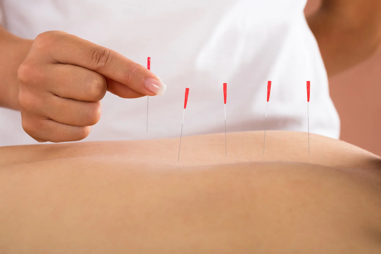 Dry needling is the process of inserting a hypodermic needle into the body without injecting any substance. In certain cases, ultrasound-guided dry needling is necessary to identify damaged parts, such as tendons.