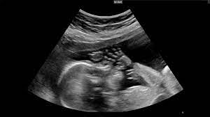 Fetal morphology ultrasound, also known as the 19-20 week scan or the second-trimester ultrasound, is one of the important scans of the pregnancy, during which a rigorous and generalized assessment of the fetus is performed.
