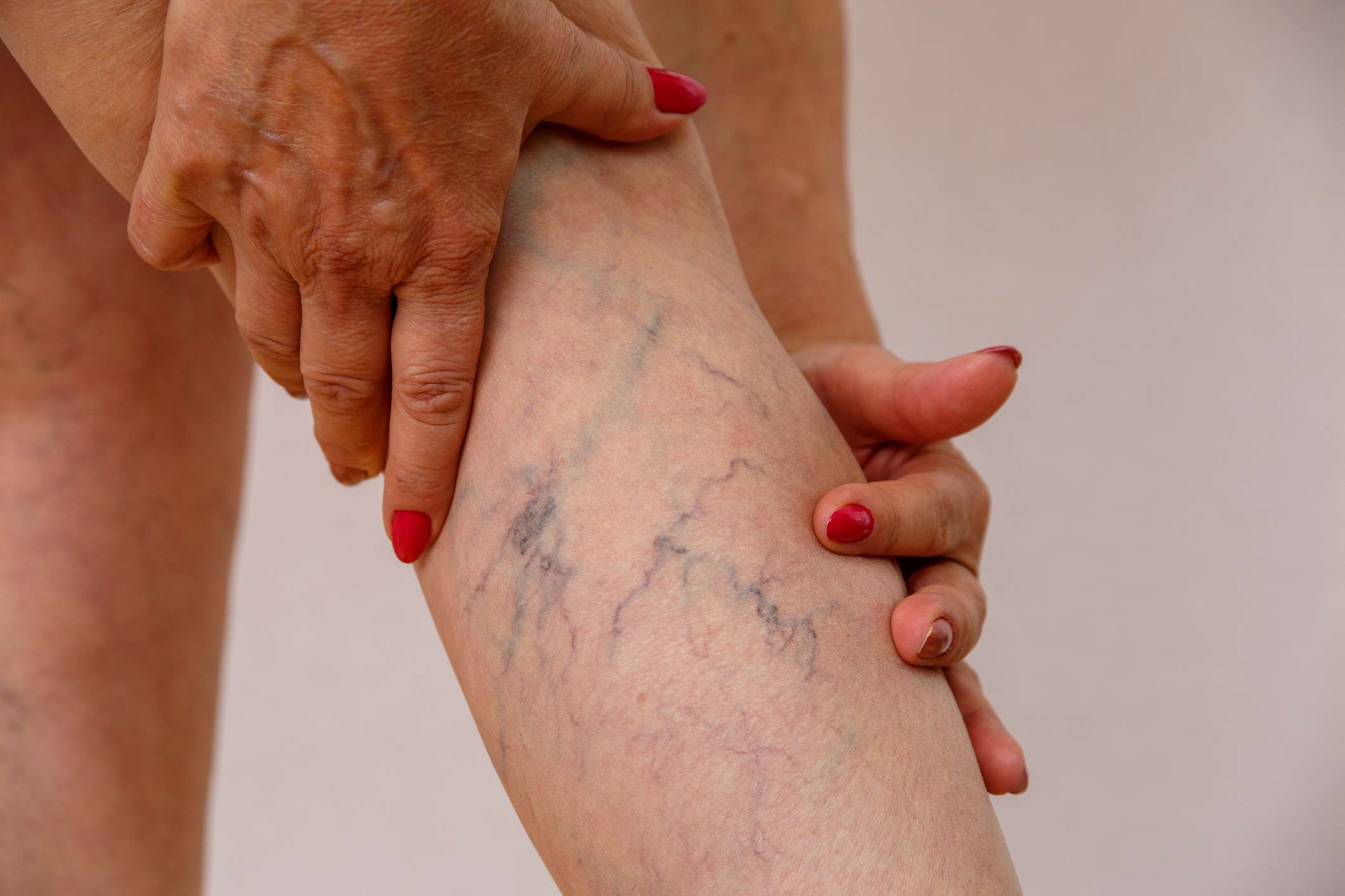 Varicose veins are described as swollen and twisted veins sometimes surrounded by patches of flooded capillaries known as spider veins. They mostly appear on legs and feet. Although they can be mildly painful and disfiguring, they are usually considered harmless. When exacerbated, they become can hinder circulation to the point of causing swollen ankles, itchy skin, and aching in the affected limb.