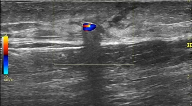 Ultrasound scanners can identify a range of soft-tissue foreign materials, such as wood splinters, glass, metal, and plastic, as well as evaluate the soft-tissue problems that come with them.