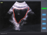 bladder-imaging-wireless-ultrasound.jpg