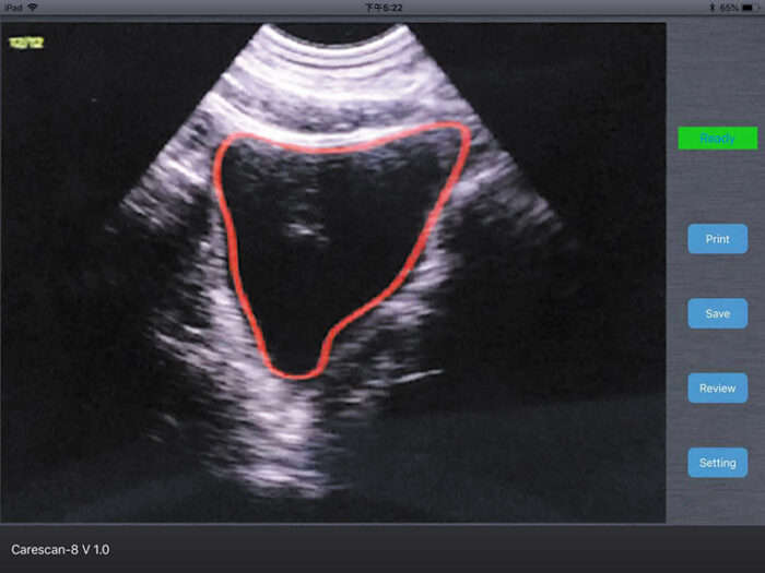 bladder-imaging-wireless-ultrasound.jpg