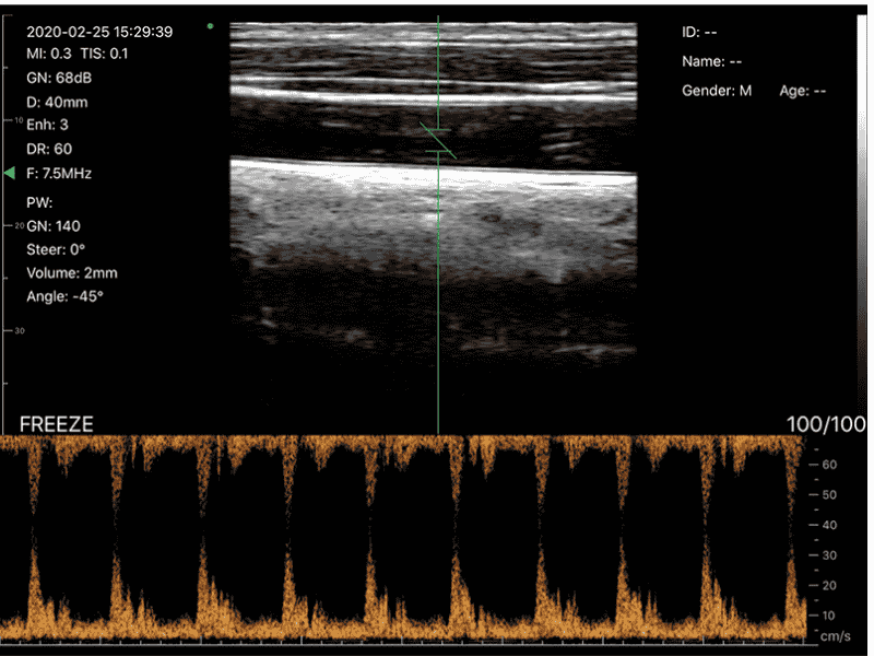 The Vsono-L1 is a high-performance wireless linear ultrasound scanner designed for vascular, musculoskeletal, nerve, and small-parts imaging. Its 128-element high-frequency probe delivers superior resolution and accuracy, with advanced Doppler modes for professional diagnostics.