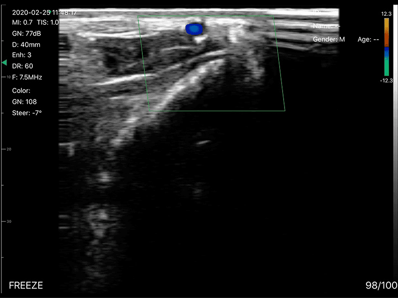 The Vsono-L1 is a high-performance wireless linear ultrasound scanner designed for vascular, musculoskeletal, nerve, and small-parts imaging. Its 128-element high-frequency probe delivers superior resolution and accuracy, with advanced Doppler modes for professional diagnostics.