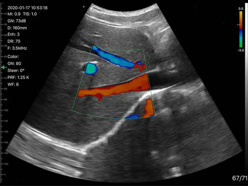 Triple Head Color Doppler Ultrasound Scanner: Vsono-CL4 is a wireless ultrasound probe that contains 3 heads in 1 device. The ultrasound scanner can be used for patient examination where a linear, convex, and/or phased array transducer is required for medical imaging. The Vsono-CL4 is compatible with Android and iOS smartphones and tablets. Thanks to its high number of elements (192), this wireless ultrasound scanner provides a high-quality image allowing for a fast and efficient diagnosis.