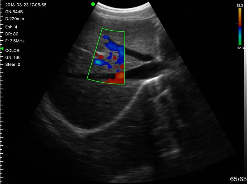 Color Doppler Convex Transvaginal Ultrasound Scanner: Vsono-TVU1 is a wireless ultrasound probe that contains 2 probes in 1 device: A transvaginal probe + A convex probe.