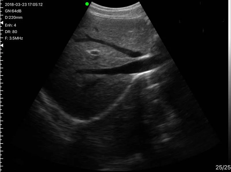 Color Doppler Convex Transvaginal Ultrasound Scanner: Vsono-TVU1 is a wireless ultrasound probe that contains 2 probes in 1 device: A transvaginal probe + A convex probe.