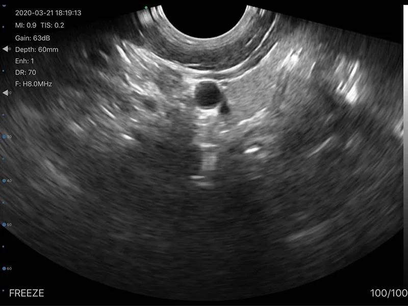 Color Doppler Convex Transvaginal Ultrasound Scanner: Vsono-TVU1 is a wireless ultrasound probe that contains 2 probes in 1 device: A transvaginal probe + A convex probe.