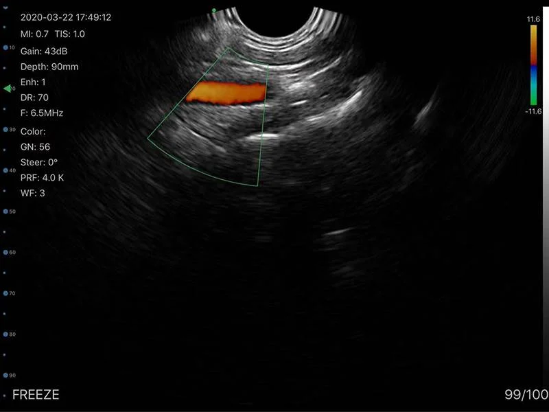Color Doppler Convex Transvaginal Ultrasound Scanner: Vsono-TVU1 is a wireless ultrasound probe that contains 2 probes in 1 device: A transvaginal probe + A convex probe.