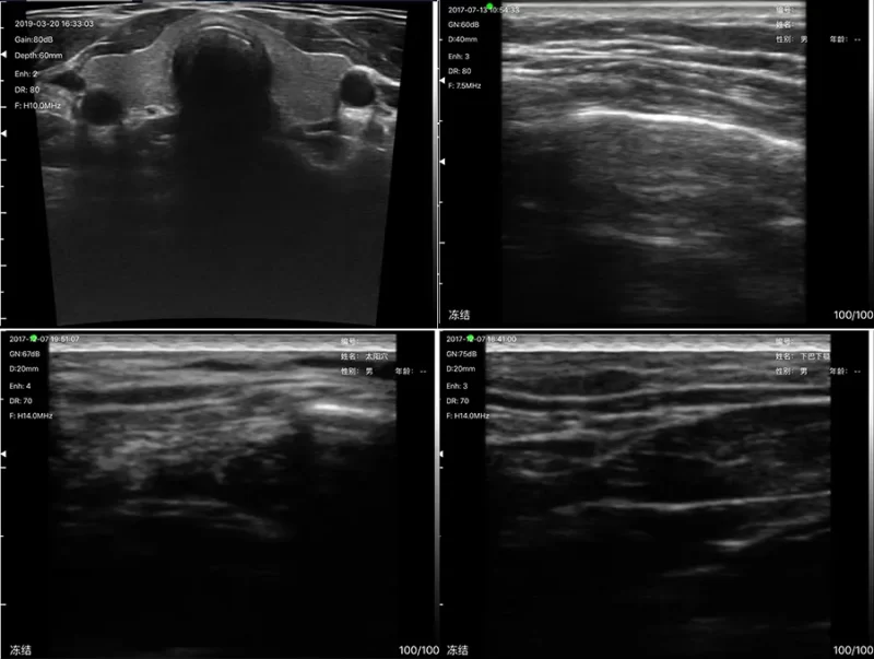 Doppler Super Width Linear Ultrasound: Vsono-SW1 - Image 3
