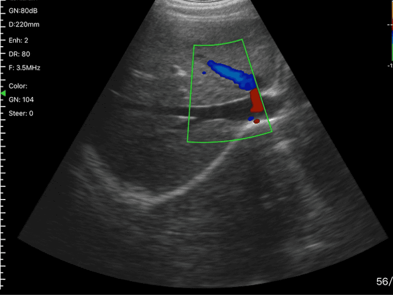 The Vsono-L1 is a high-performance wireless linear ultrasound scanner designed for vascular, musculoskeletal, nerve, and small-parts imaging. Its 128-element high-frequency probe delivers superior resolution and accuracy, with advanced Doppler modes for professional diagnostics.