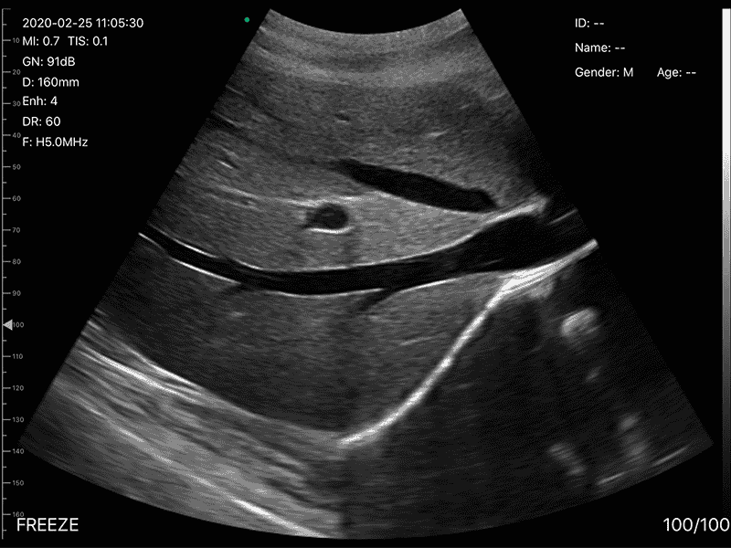 The Vsono-L1 is a high-performance wireless linear ultrasound scanner designed for vascular, musculoskeletal, nerve, and small-parts imaging. Its 128-element high-frequency probe delivers superior resolution and accuracy, with advanced Doppler modes for professional diagnostics.