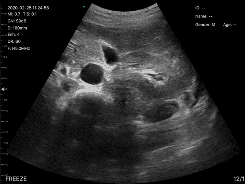 The Vsono-L1 is a high-performance wireless linear ultrasound scanner designed for vascular, musculoskeletal, nerve, and small-parts imaging. Its 128-element high-frequency probe delivers superior resolution and accuracy, with advanced Doppler modes for professional diagnostics.
