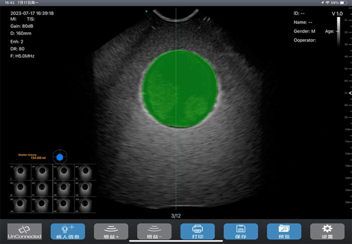 bladder ultrasound scanner