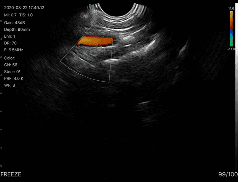 The Vsono-TVU3 is a versatile dual-head wireless ultrasound scanner, integrating a linear probe (L40) and a transvaginal probe (R13) in a single compact device. Designed for gynecology, obstetrics, reproductive health, and small-part imaging, it delivers high-resolution imaging with advanced Doppler modes and puncture assistance, ideal for both clinical and mobile settings. With 128 probe elements, 32-channel RF circuit, and a puncture assist function, the TVU3 enables precise examinations, guided procedures, and reliable diagnostics. Its lightweight, wireless design ensures seamless connection to smartphones, tablets, and computers (iOS, Android, Windows).