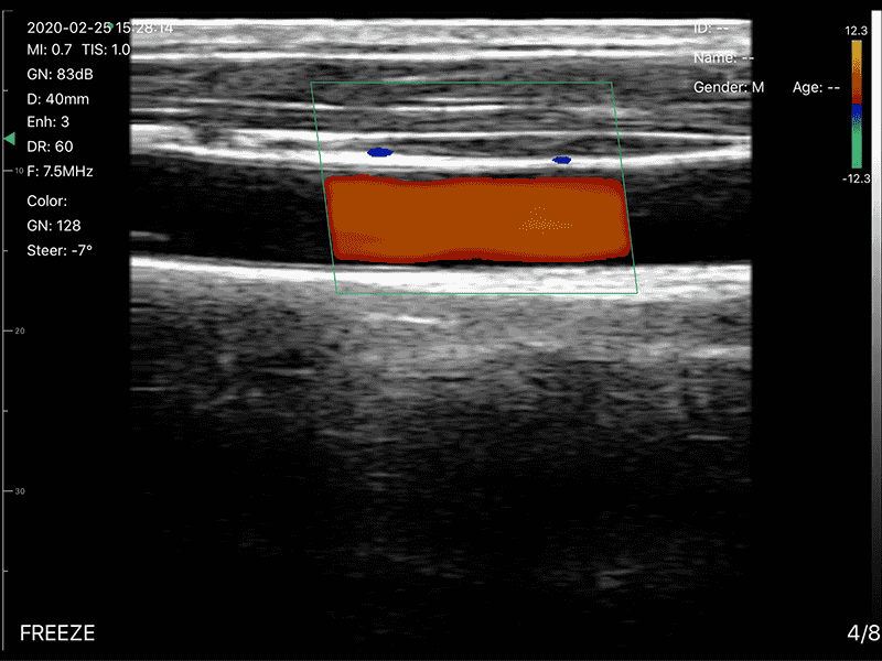 The Vsono-TVU3 is a versatile dual-head wireless ultrasound scanner, integrating a linear probe (L40) and a transvaginal probe (R13) in a single compact device. Designed for gynecology, obstetrics, reproductive health, and small-part imaging, it delivers high-resolution imaging with advanced Doppler modes and puncture assistance, ideal for both clinical and mobile settings. With 128 probe elements, 32-channel RF circuit, and a puncture assist function, the TVU3 enables precise examinations, guided procedures, and reliable diagnostics. Its lightweight, wireless design ensures seamless connection to smartphones, tablets, and computers (iOS, Android, Windows).