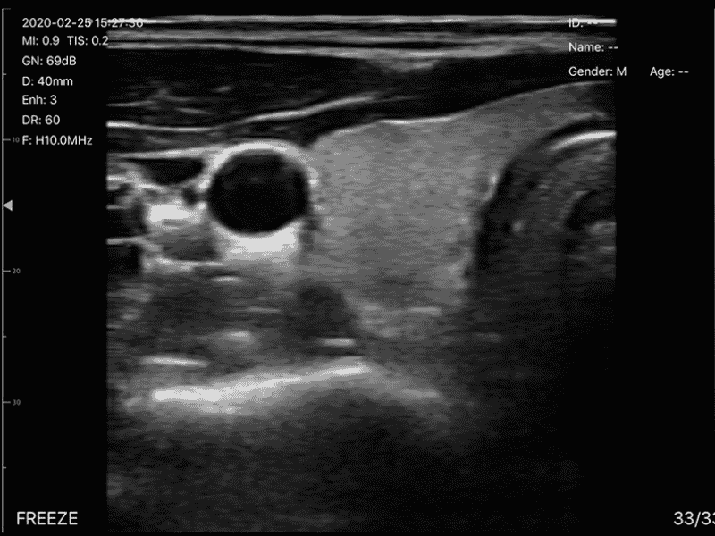 The Vsono-TVU3 is a versatile dual-head wireless ultrasound scanner, integrating a linear probe (L40) and a transvaginal probe (R13) in a single compact device. Designed for gynecology, obstetrics, reproductive health, and small-part imaging, it delivers high-resolution imaging with advanced Doppler modes and puncture assistance, ideal for both clinical and mobile settings. With 128 probe elements, 32-channel RF circuit, and a puncture assist function, the TVU3 enables precise examinations, guided procedures, and reliable diagnostics. Its lightweight, wireless design ensures seamless connection to smartphones, tablets, and computers (iOS, Android, Windows).