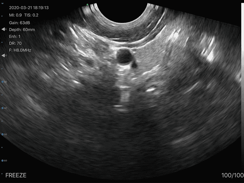 The Vsono-TVU3 is a versatile dual-head wireless ultrasound scanner, integrating a linear probe (L40) and a transvaginal probe (R13) in a single compact device. Designed for gynecology, obstetrics, reproductive health, and small-part imaging, it delivers high-resolution imaging with advanced Doppler modes and puncture assistance, ideal for both clinical and mobile settings. With 128 probe elements, 32-channel RF circuit, and a puncture assist function, the TVU3 enables precise examinations, guided procedures, and reliable diagnostics. Its lightweight, wireless design ensures seamless connection to smartphones, tablets, and computers (iOS, Android, Windows).