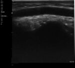 The VSONO-ML3 is a state-of-the-art, handheld linear ultrasound scanner engineered specifically for the nuances of aesthetic medicine and dermatology. By combining ultra-high frequency imaging (up to 22MHz) with a compact, wireless design, the VSONO-ML3 empowers practitioners to visualize facial anatomy with unprecedented clarity, ensuring safer injections and superior patient outcomes.