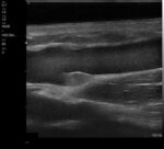 The VSONO-ML3 is a state-of-the-art, handheld linear ultrasound scanner engineered specifically for the nuances of aesthetic medicine and dermatology. By combining ultra-high frequency imaging (up to 22MHz) with a compact, wireless design, the VSONO-ML3 empowers practitioners to visualize facial anatomy with unprecedented clarity, ensuring safer injections and superior patient outcomes.