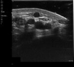 The VSONO-ML3 is a state-of-the-art, handheld linear ultrasound scanner engineered specifically for the nuances of aesthetic medicine and dermatology. By combining ultra-high frequency imaging (up to 22MHz) with a compact, wireless design, the VSONO-ML3 empowers practitioners to visualize facial anatomy with unprecedented clarity, ensuring safer injections and superior patient outcomes.