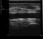 The VSONO-ML3 is a state-of-the-art, handheld linear ultrasound scanner engineered specifically for the nuances of aesthetic medicine and dermatology. By combining ultra-high frequency imaging (up to 22MHz) with a compact, wireless design, the VSONO-ML3 empowers practitioners to visualize facial anatomy with unprecedented clarity, ensuring safer injections and superior patient outcomes.